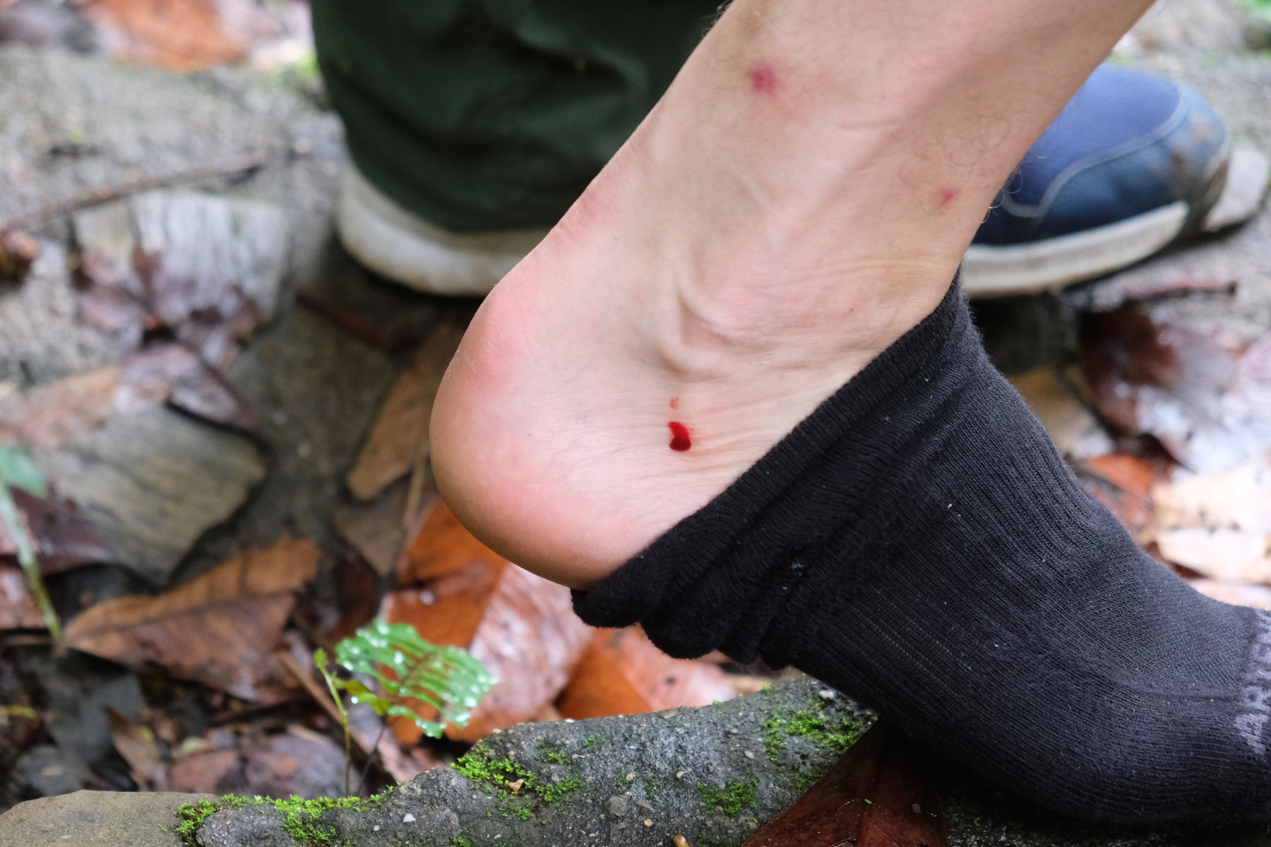 Ein Fuß mit einer blutenden Wunde, verursacht von einem Blutegel.